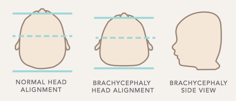 brachycephaly