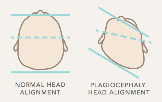 plagiocephaly photo